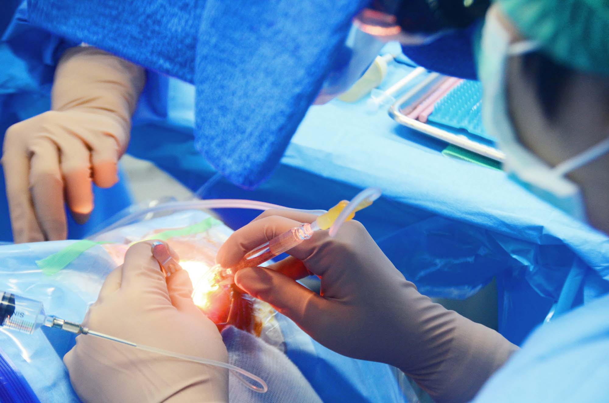 Treatment of a cataract by a surgical method